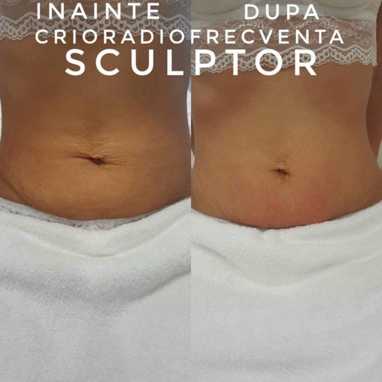 Crio-Radiofrecvența, la Salonul Avenue Dee din Târgoviște. Un tratament cu rezultate spectaculoase de la prima ședință