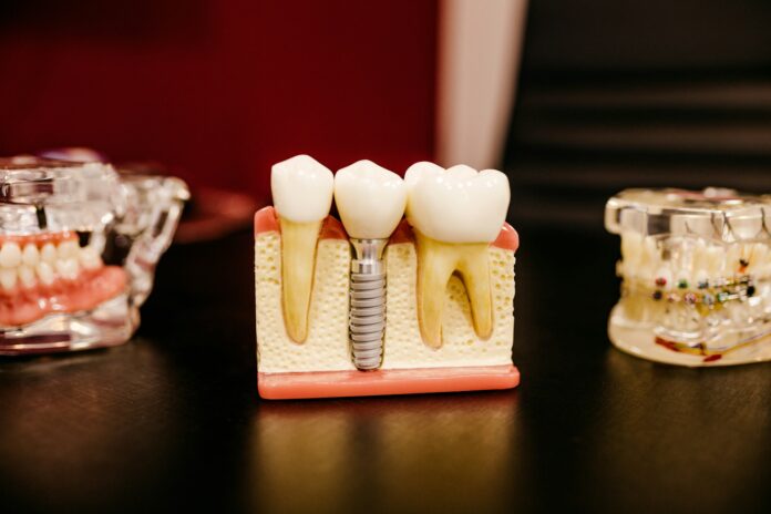 Merită să îți pui un implant dentar Află tot ce trebuie să știi înainte să iei decizia